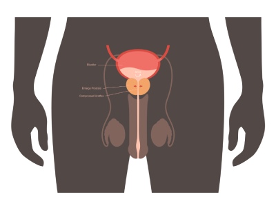dysurie zvětšená prostata